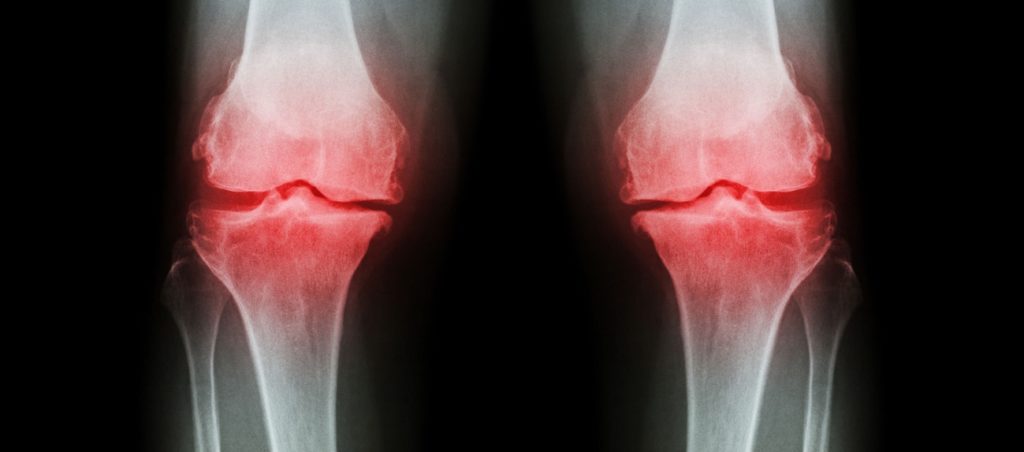 Osteoporosis Physical Therapy