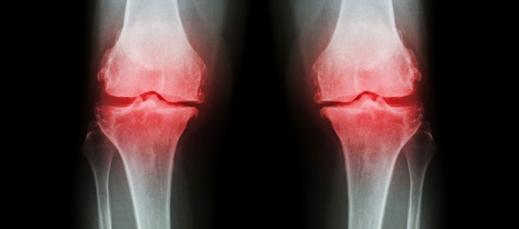 Osteoporosis Physical Therapy