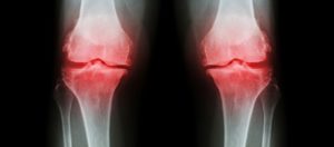 Osteoporosis Physical Therapy
