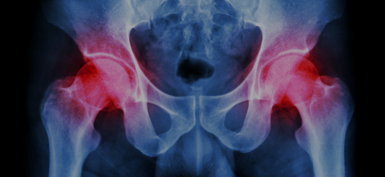 Hip Replacement Physical Therapy
