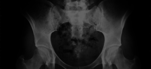 Pelvic Physical Therapy