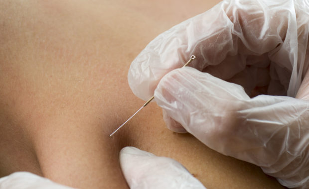 Dry Needling