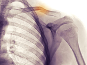 collarbone fracture