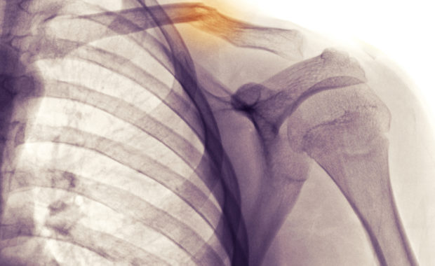 collarbone fracture