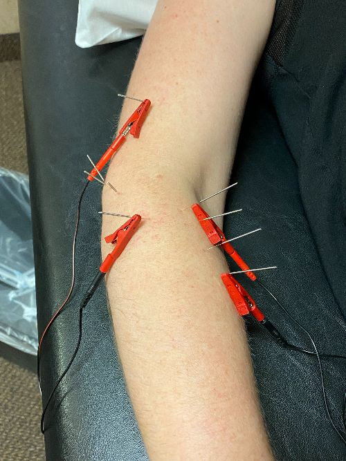 What is Dry Needling?  Preferred Physical Therapy